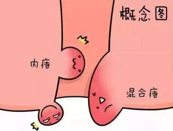 痔疮长什么样子的？痔疮的早期症状，痔疮图片真人图